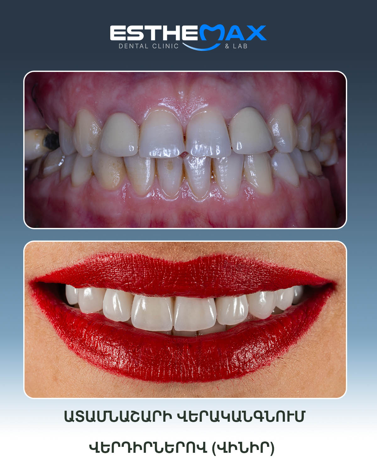 Implant restoration - before and after